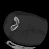 SPORK, NICO - 22.03.1976 - 02.08.2022 - CT obere Extremität - 17:59:38